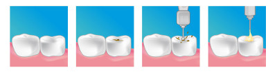 Centre implant dentaire Chalon-Sur-Saone